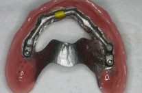 Proteza na implantatima