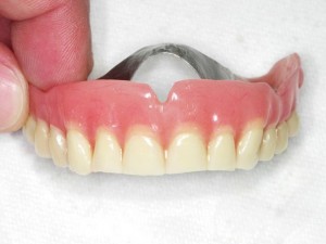 Proteza na implantatima