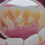 Zubni kamenac